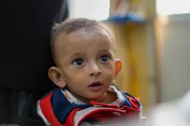  سوء التغذية وأثره على صحة الأطفال